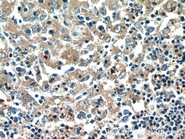 PFKP Antibody in Immunohistochemistry (Paraffin) (IHC (P))