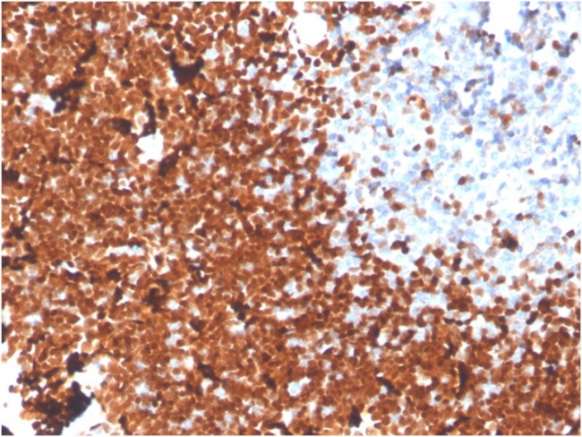 TdT/DNA Nucleotidylexotransferase (Acute Lymphoblastic Leukemia Marker) Antibody in Immunohistochemistry (Paraffin) (IHC (P))