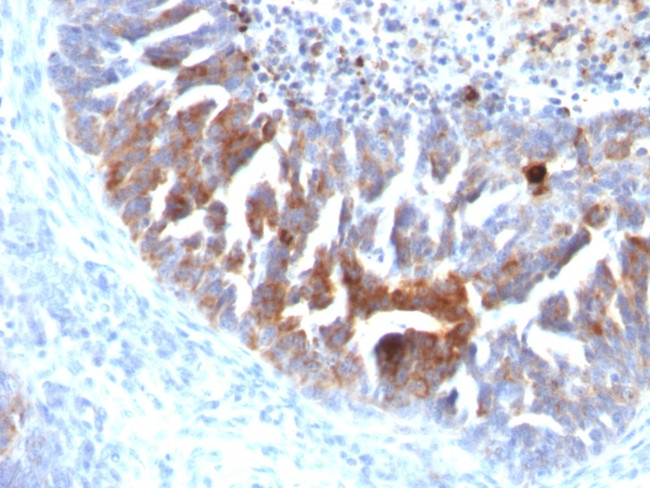 TAG-72/CA72.4 (Tumor-Associated Glycoprotein) Antibody in Immunohistochemistry (Paraffin) (IHC (P))