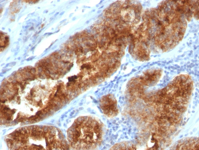 TAG-72/CA72.4 (Tumor-Associated Glycoprotein) Antibody in Immunohistochemistry (Paraffin) (IHC (P))