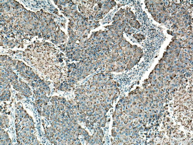 MUC1/CA15-3 Antibody in Immunohistochemistry (Paraffin) (IHC (P))