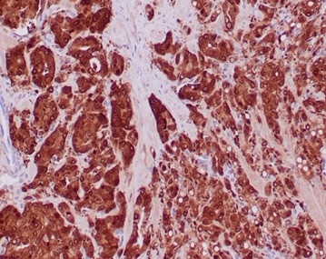 IDH1-R132H (Isocitrate Dehydrogenase) Antibody in Immunohistochemistry (Paraffin) (IHC (P))