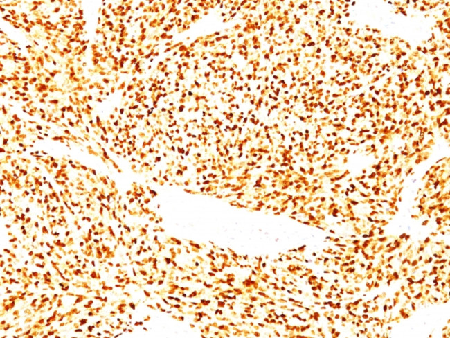 MyoD1 (Rhabdomyosarcoma Marker) Antibody in Immunohistochemistry (Paraffin) (IHC (P))