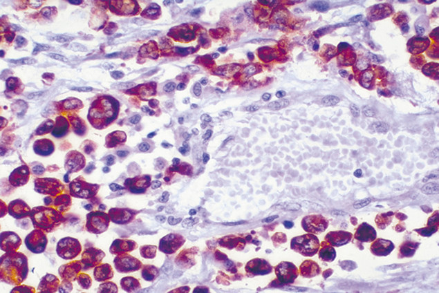 ALK Antibody in Immunohistochemistry (IHC)