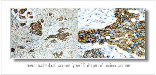 HER2/ErbB2 Antibody in Immunohistochemistry (IHC)