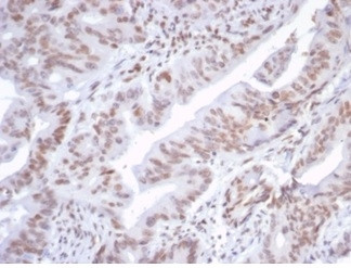 ATRX/RAD54 (Alpha Thalassemia Mental Retardation) Antibody in Immunohistochemistry (Paraffin) (IHC (P))