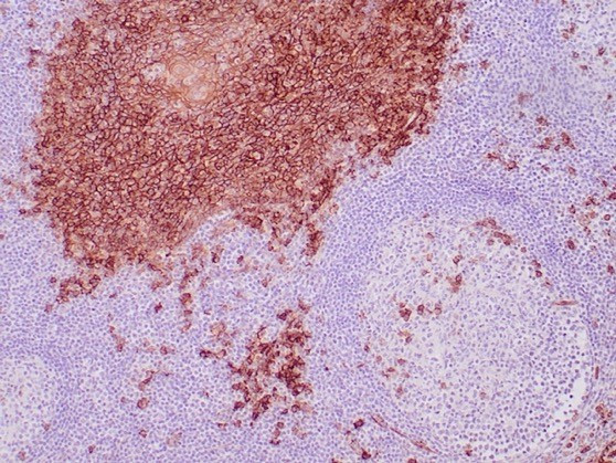 CD138/Syndecan-1 (SDC1) (Plasma Cell Marker) Antibody in Immunohistochemistry (Paraffin) (IHC (P))