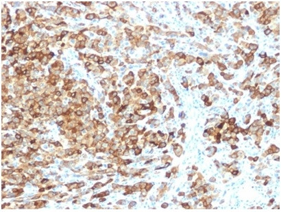 gp100/Melanosome/PMEL17/SILV (Melanoma Marker) Antibody in Immunohistochemistry (Paraffin) (IHC (P))