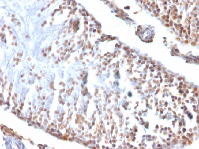 Wilm's Tumor 1 (WT1) (Wilm's Tumor and Mesothelial Marker) Antibody in Immunohistochemistry (Paraffin) (IHC (P))