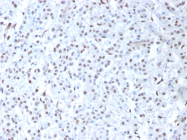 Wilm's Tumor 1 (WT1) (Wilm's Tumor and Mesothelial Marker) Antibody in Immunohistochemistry (Paraffin) (IHC (P))