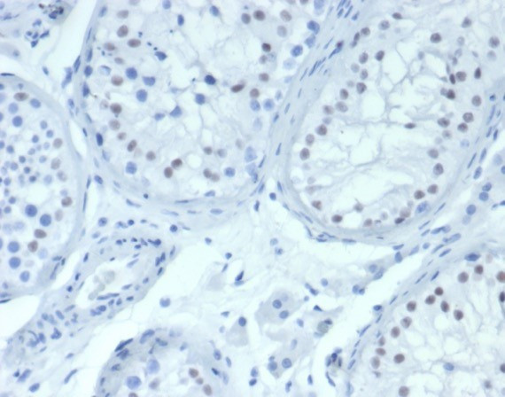 Wilm's Tumor 1 (WT1) (Wilm's Tumor and Mesothelial Marker) Antibody in Immunohistochemistry (Paraffin) (IHC (P))