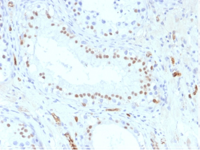 Wilm's Tumor 1 (WT1) (Wilm's Tumor and Mesothelial Marker) Antibody in Immunohistochemistry (Paraffin) (IHC (P))