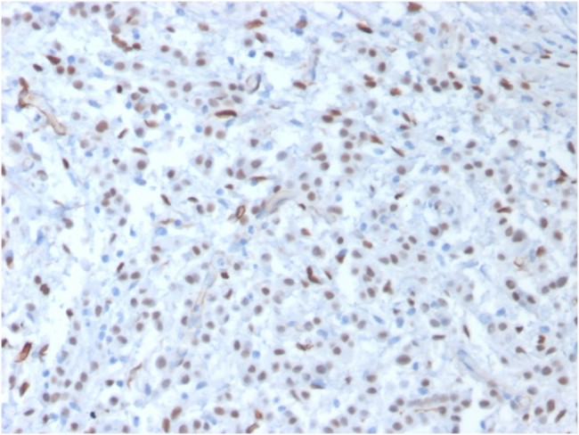 Wilm's Tumor 1 (WT1) (Wilm's Tumor and Mesothelial Marker) Antibody in Immunohistochemistry (Paraffin) (IHC (P))