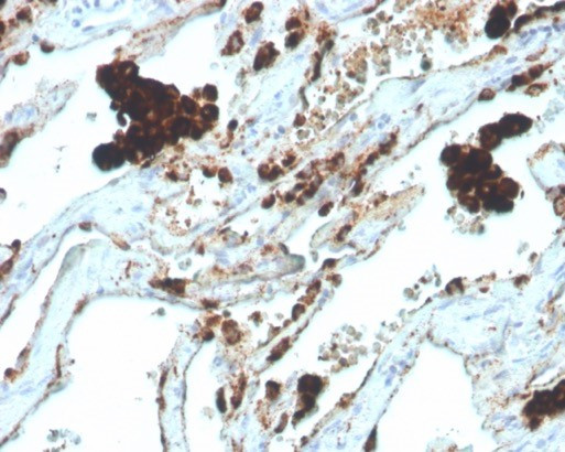 Napsin A (Lung Adenocarcinoma Marker) Antibody in Immunohistochemistry (Paraffin) (IHC (P))