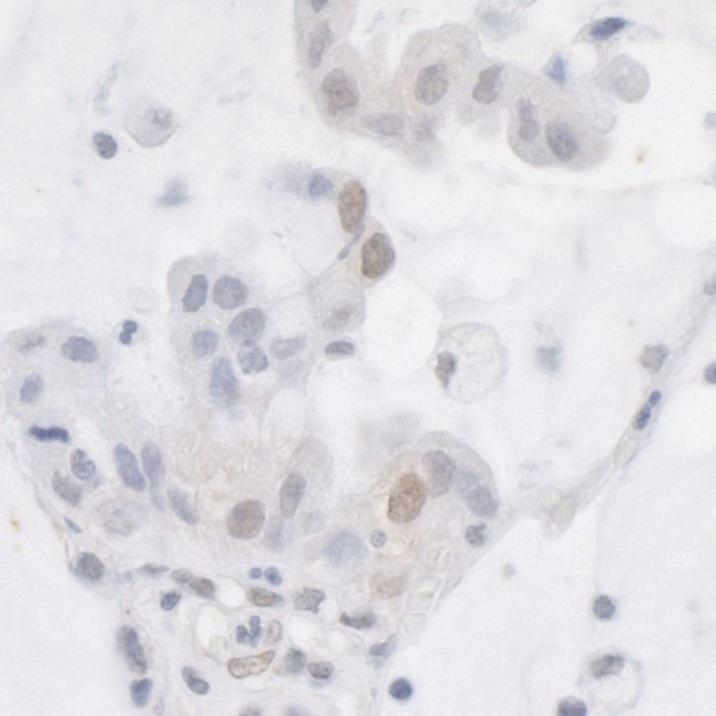 ATRX Antibody in Immunohistochemistry (IHC)