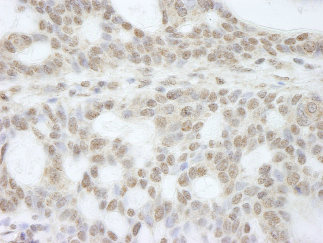 ATRX Antibody in Immunohistochemistry (IHC)