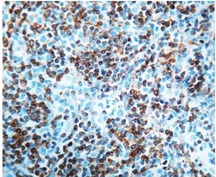 Bcl-2 Antibody in Immunohistochemistry (Paraffin) (IHC (P))