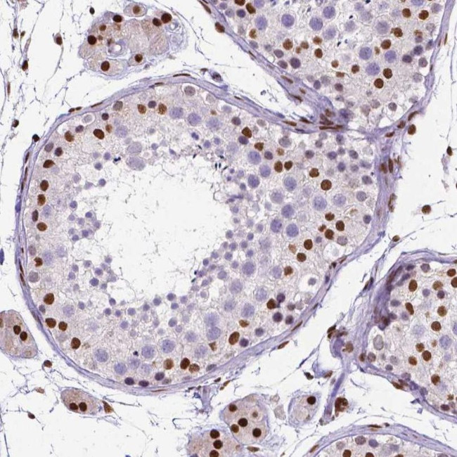 ATRX Antibody in Immunohistochemistry (IHC)