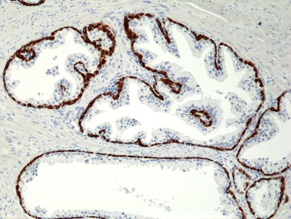 Cytokeratin 5/6 Antibody in Immunohistochemistry (Paraffin) (IHC (P))