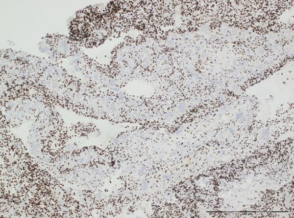 H3.3 G34W Antibody in Immunohistochemistry (IHC)