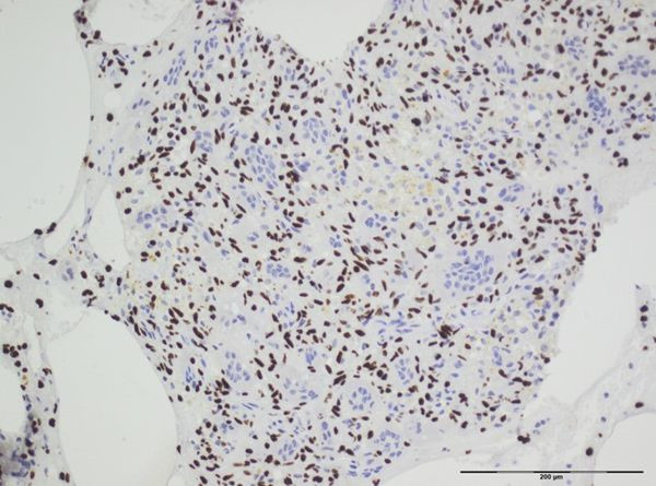 H3.3 G34W oncohistone mutant Antibody in Immunohistochemistry (IHC)