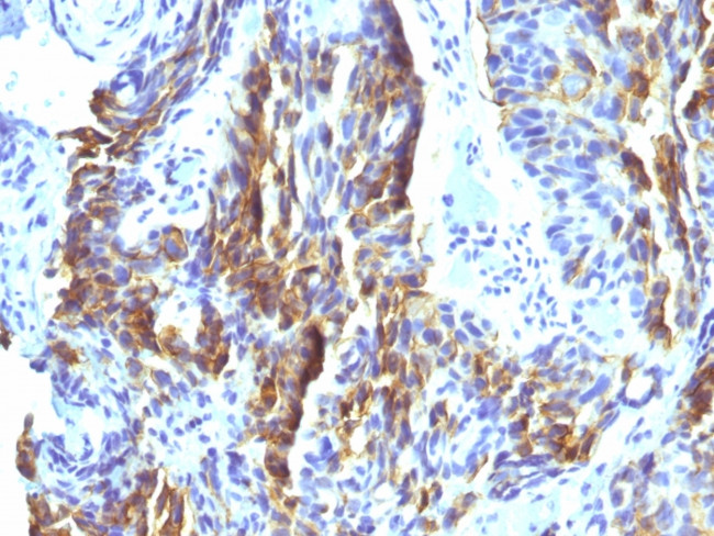 KBA.62 (Melanoma Associated Antigen) Antibody in Immunohistochemistry (Paraffin) (IHC (P))