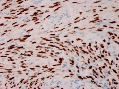 Human Herpes Virus 8 (HHV8) Antibody in Immunohistochemistry (Paraffin) (IHC (P))