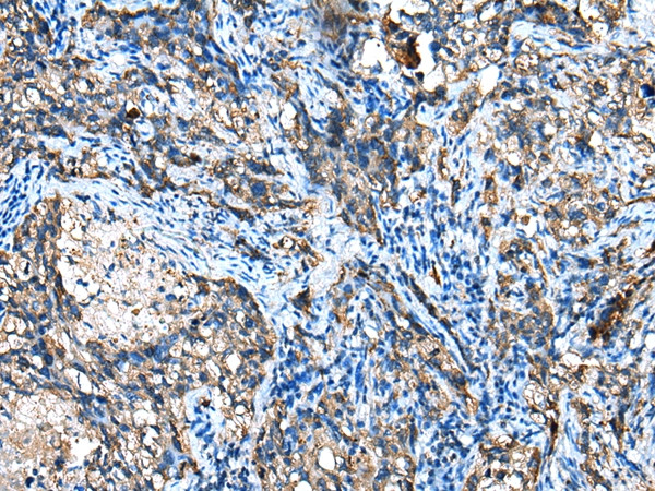 IGF2BP3 Antibody in Immunohistochemistry (Paraffin) (IHC (P))