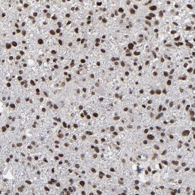 ATRX Antibody in Immunohistochemistry (IHC)