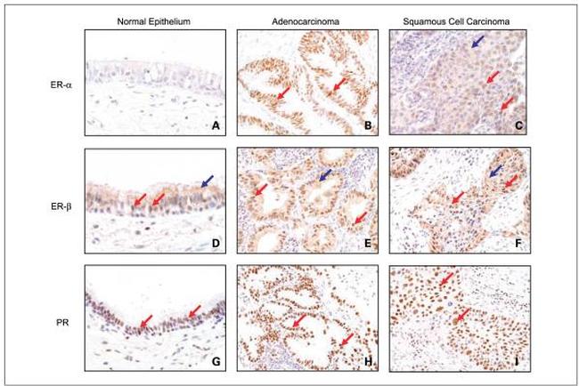 Progesterone Receptor Antibody in Immunohistochemistry (IHC)