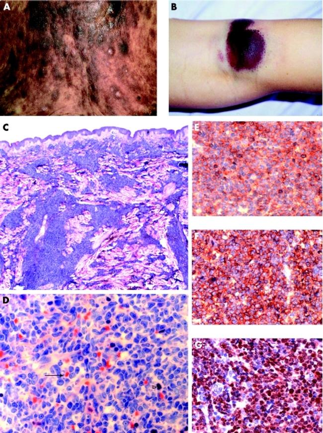 CD123 Antibody in Immunohistochemistry, Immunohistochemistry (Frozen) (IHC, IHC (F))