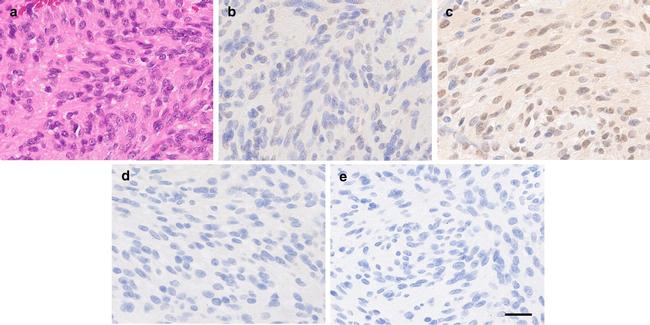 Progesterone Receptor Antibody in Immunohistochemistry (IHC)