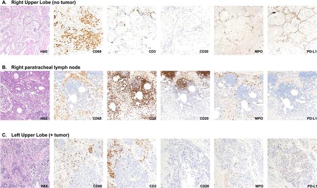 PD-L1 Antibody in Immunohistochemistry (IHC)